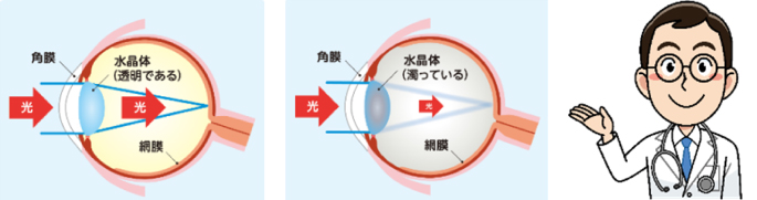 白内障とは